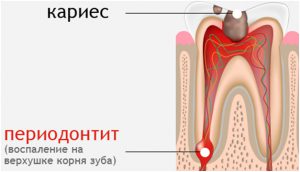 кариес и периодонтит кариес и периодонтит