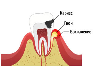 кариес с хронические периодонтитом кариес с хронические периодонтитом